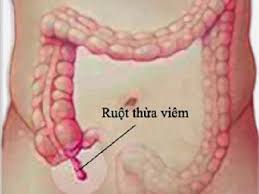 Những biến chứng nguy hiểm do viêm ruột thừa